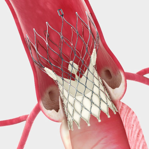 A medical illustration showing a close-up of a valve repair