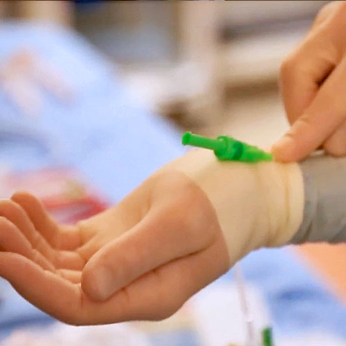 A close-up of a hand and bandaged wrist with a catheter line, called a transradial approach