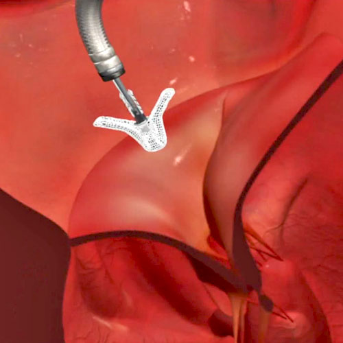 A medical image showing mitral valve flaps