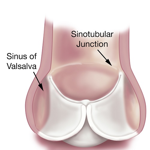 A medical illustration showing Sinus of Valsalva and Sinotubular Junction