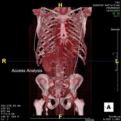 A medical image showing the chest of a human skeleton with aortic valve disease